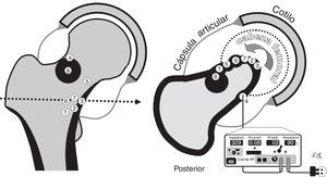 Representación esquemática de los osteomas osteoides de nuestra serie. A la izquierda, en visión coronal. A la derecha, en visión axial, proyectando en el mismo corte todos los nidus (con un número en su centro que corresponde a cada caso). La cortical y el hueso reactivo se representan en color negro y la cápsula articular en gris, con la cavidad articular distendida por la sinovitis. En la parte inferior derecha de la figura se representa el aparato de radiofrecuencia y el abordaje posterior al caso n.° 4. El resto fueron abordados por vía anterior, con más o menos rotación externa del miembro para hacer más accesible el nidus (flecha curvada).
