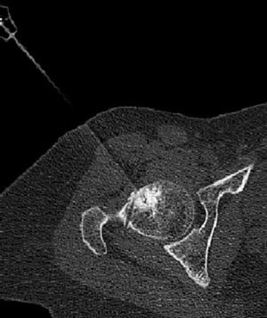Corte axial de TC de la termoablación del nidus en el caso n.° 8. Se observa la punta del electrodo en el centro del nidus y se adivina el trayecto erróneo que llevó el trocar en el primer intento de abordarlo.
