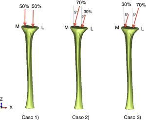 Cargas y condiciones de contorno. M: medial; L: lateral.