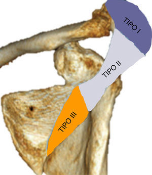 Clasificación de las fracturas de acromion según Levy et al.16.