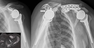 Fractura de la espina de la escápula. Osteosíntesis con placas LC-DCP.