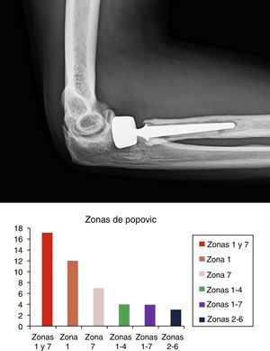 Imagen superior: ejemplo de osteólisis periprotésica en zonas 1-7 de Popovic. Prótesis bipolar cementada a los 3 años de su implantación. Imagen inferior: distribución de osteólisis periprotésica en nuestra serie según las distintas zonas de Popovic. Las zonas 1 y 7 fueron las más afectadas.