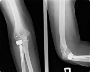 Ejemplo de sobredimensionado de la cabeza. Obsérvese la hiperpresión del componente protésico sobre el capitellum y la apertura asimétrica de la articulación cúbito-humeral, siendo mayor en su vertiente externa. Requirió la retirada protésica.