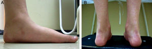 A) y B) Imágenes de uno de los pacientes evaluados para pie plano laxo con los criterios descritos