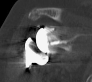 TAC en plano coronal. Fractura no desplazada de acromion.