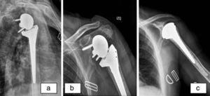 Complicación por aflojamiento de la metaglena. a) Radiografía a los 3 meses de la cirugía, observando inicio de notching. b) Notching grado 4. c) Radiografía a los 8 meses de la reconversión a hemiartroplastia.