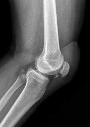Rx simple (proyección lateral) de la rodilla del primer paciente, a los 2 años de evolución.