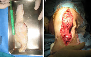 A) Homoinjerto de aparato extensor. B) Reconstrucción con homoinjerto de aparato extensor en el segundo paciente.
