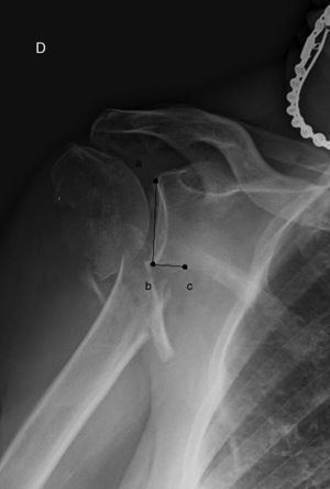 Ángulo del cuello de la escapula (en la proyección anteroposterior verdadera de hombro fracturado): formado por la intersección de una línea trazada desde el borde superior de la glena (punto a) al punto más inferior de esta (b), y desde el punto más inferior de la glena (b) a otro situado un centímetro medialmente siguiendo el reborde glenoideo (c).