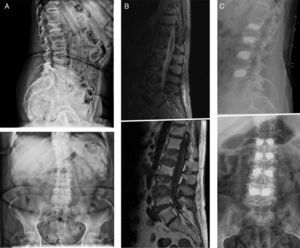 A) Primera a la izquierda: paciente con mieloma múltiple y diversas fracturas vertebrales. B) En el centro: imagen de resonancia magnética confirma el origen agudo de las fracturas (edema). C) Tercera a la derecha: cifoplastia bilateral percutánea, con un resultado radiológico satisfactorio, sin complicaciones asociadas.