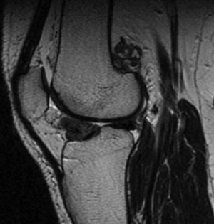 Imagen sagital de RM (adquisición T2) de un paciente con SVP en compartimento anterior y posterior de la rodilla (SVPD).