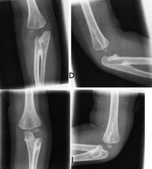 Radiografías de ambos codos que muestran una sinostosis radiocubital bilateral.