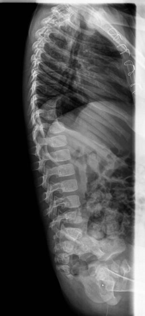 Radiografía de columna sin alteraciones destacables.