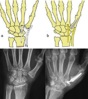 Esquemas y radiografías postoperatorias de las técnicas quirúrgicas del estudio: a) artroplastia de suspensión-resección; b) artroplastia con prótesis.