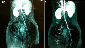Arteriografía venosa con estenosis de la arteria íliaca común derecha y obstrucción de la arteria íliaca y femoral derecha (caso 6).
