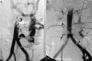 a) Arteriografía que muestra fístula arteriovenosa ilio-lumbar izquierda. b) Resultado final tras la embolización.