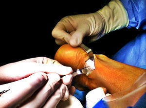 Fotografía intraoperatoria; microtenotomía por radiofrecuencia.
