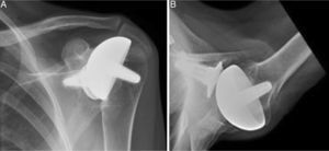 Radiografías de hombro izquierdo de mujer de 45 años de edad (artritis reumatoide juvenil), A) anteroposterior y B) axilar en las que se aprecia artroplastia total de superficie de hombro Copeland®, previa a cirugía de revisión por rotura secundaria del manguito rotador y aflojamiento del componente glenoideo.