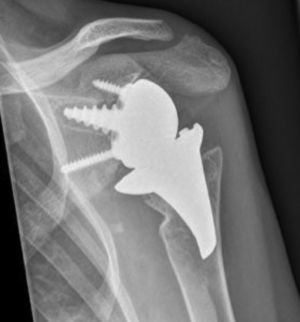 Radiografía anteroposterior de hombro izquierdo realizada 24 meses tras la cirugía de recambio, en la que se aprecia artroplastia total invertida de hombro Verso® como implante de revisión.