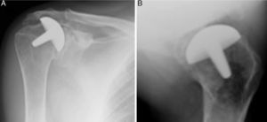 Radiografías de hombro derecho de hombre de 58 años de edad, en proyección anteroposterior A) y axilar B), en las que se aprecia hemiartroplastia de superficie Copeland®, previa a cirugía de revisión por rotura secundaria e insuficiencia del manguito rotador. En la figuraA) se puede apreciar el acentuado ascenso de la cabeza humeral.