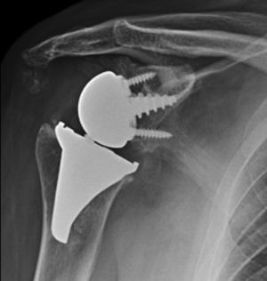 Radiografía anteroposterior de hombro derecho realizada 12 meses tras la artroplastia de revisión, en la que se aprecia artroplastia total invertida de hombro Verso® como implante de revisión.