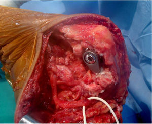 Aspecto del aparato extensor después de colocado el implante y transposición anterior del nervio cubital.