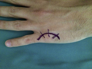 Incisión arciforme dorsal centrada en la articulación MCF.