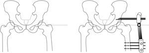 Técnica quirúrgica de artrodiastasis articulada. En primer lugar se localiza el centro de rotación de la cabeza femoral mediante escopia y se coloca una aguja de Kirschner que nos servirá como referencia. A continuación, colocamos 3 tornillos supraacetabulares, transversales al eje mayor del fémur, y 3 tornillos diafisarios. Cobra especial interés la situación de la bisagra del fijador externo sobre el centro de rotación, por lo que lo haremos coincidir con la aguja guía. Previamente a la fijación del montaje, realizaremos una abducción de la extremidad a 15-20˚ que permita la sedestación del paciente.