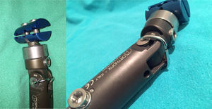 Rotura del fijador externo y solución mediante alambre de acero inoxidable, tanto a nivel de la bisagra principal, como de la unión al T-clamp.