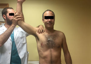 Prueba de aprensión de Liu: el paciente debe estar en sedestación o bipedestación. El explorador se sitúa detrás y le coge el brazo llevándolo a 120° de abducción y 90° de rotación externa. Con la otra mano le sujeta el hombro con el pulgar por detrás y los dedos por delante.