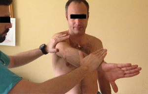 Test de O‘Brein: paciente con hombro a 90° de flexión, 10° de aducción y rotación interna máxima, con codo extendido. Se solicita elevación resistida que evoca dolor en región bicipital.