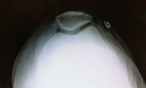 Radiografía axial postoperatoria que muestra la osteotomía realizada.