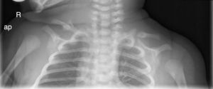 Radiografía del paciente a la semana de edad donde se aprecia seudoartrosis de ambas clavículas.
