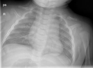 Radiografía del paciente a los 4 meses de edad donde se confirma seudoartrosis de ambas clavículas.