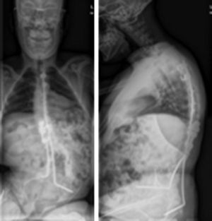 Radiografías en las que se aprecia movilización del anclaje ilíaco izquierdo.