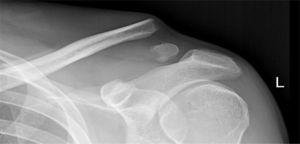 Caso número 1. Radiografía anteroposterior de clavícula izquierda que muestra una fractura tipo ii-b de clavícula distal de Neer. L: left (izquierdo).
