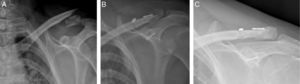 Caso número 2. Radiografía anteroposterior de clavícula con 30° de inclinación cefálica. A)Preoperatorio. B)Postoperatorio inmediato. C)Consolidación radiológica a las 12 semanas de la intervención.