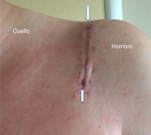 Caso número 8. Cicatriz hipertrófica presente en la revisión de los 2 meses. Podemos observar la extrusión de suturas del tejido subcutáneo en la parte proximal y distal de la herida (flechas blancas).