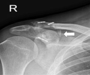 Caso número 3. La radiografía anteroposterior de clavícula muestra la osificación del trayecto coracoclavicular a los 6meses de la cirugía (flecha blanca). R: right (derecho).