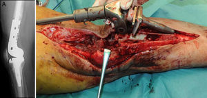 Radiografía lateral de una prótesis tumoral de rodilla con diagnóstico de infección periprotésica (A). Momento de la extracción de los implantes infectados (B).