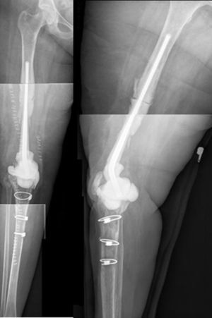 Radiografía postoperatoria (anteroposterior y lateral) del espaciador. El espaciador de cadera puede introducirse cuanto sea necesario para lograr la tensión deseada sobre las partes blandas y evitar el acortamiento de la extremidad.