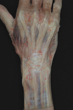 Variación del patrón de inervación cutánea del dorso de la mano proveniente del nervio radial. Publicado con permiso del editor. Fuente: García-Elías et al.1 © Masson, S.A. 2007. Todos los derechos reservados.