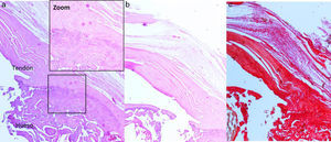 Reparación con transportador y rhBMP-2: a) tinción con hematoxilina-eosina. Zona de transición normal, presencia de haces de colágeno con orientación uniforme (++); b y c) tinciones con hematoxilina-eosina y rojo sirio. Matriz de colágeno con orientación paralela (+).