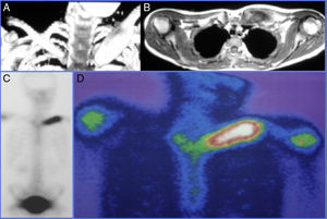 Paciente 3. Imágenes TAC, RMN y PET-TAC de foco de OCR en clavícula izquierda. A) TAC reconstrucción tridimensional de lesión en clavícula. B) Imagen de RMN. C) y D) Imágenes de PET–TAC donde se observa aumento del metabolismo en el foco inflamatorio de la clavícula izquierda.
