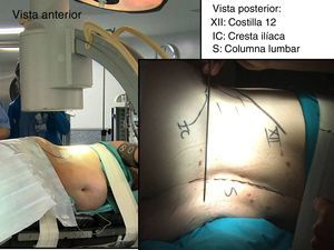 Cirugías realizadas con el paciente colocado en decúbito lateral, en una mesa radiotransparente y quebrada en la zona lumbosacra.