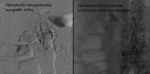 Gran hematoma retroperitoneal por sangrado activo (izquierda) que fue tratado por el servicio de cirugía vascular controlando el sangrado (derecha).