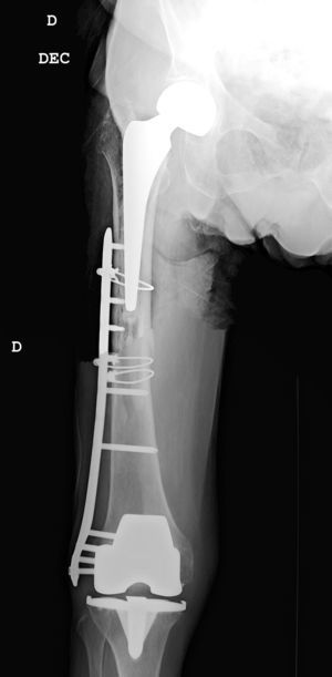 Osteosíntesis con placa lateral estabilizada con tornillos y cerclaje. Solapamiento de la placa insuficiente con evolución satisfactoria.