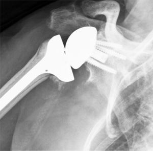 Notching escapular de tipo II según la clasificación de Sirveaux14 (llega hasta el tornillo inferior). La mayoría de los pacientes no presentaron notching o presentaron notching de tipo I.