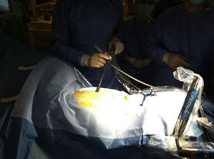 Cámara de toracoscopia con soporte neumático fijado a la mesa quirúrgica.