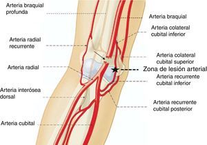 Localización de la lesión vascular cuando se produce una luxación posterior del codo por extensión (*). Una fuerza de mayor magnitud y mantenida en el tiempo puede seccionar también la arteria braquial (flecha).